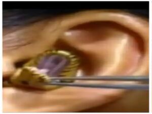 mahila ke kan me sap